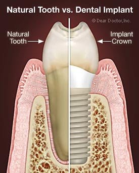 Implants at Valley Oak Family Dentistry Livermore