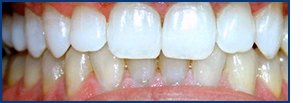 Teeth Whitening at Valley Oak Family Dentistry in Livermore